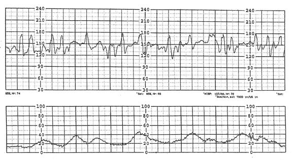Fetal-Heart-Monitor-Strips2